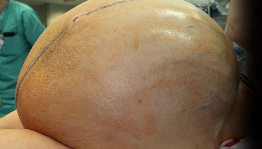 ovarian tumour