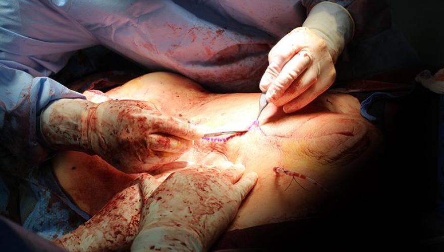 tumour removal