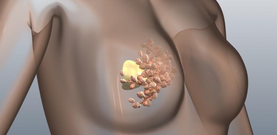 breast cancer illustration