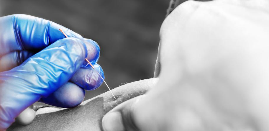 Acupuncture