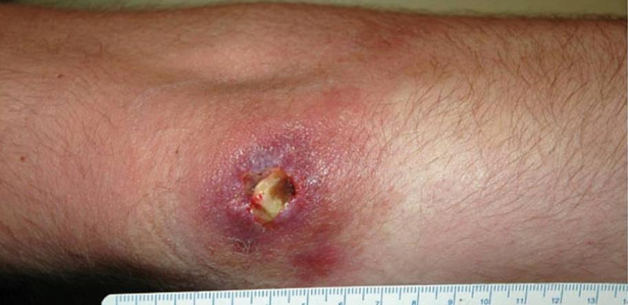 Buruli ulcer