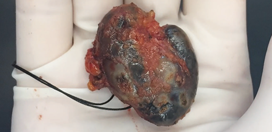 Lymphoma