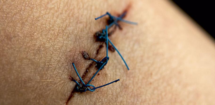 Melanoma