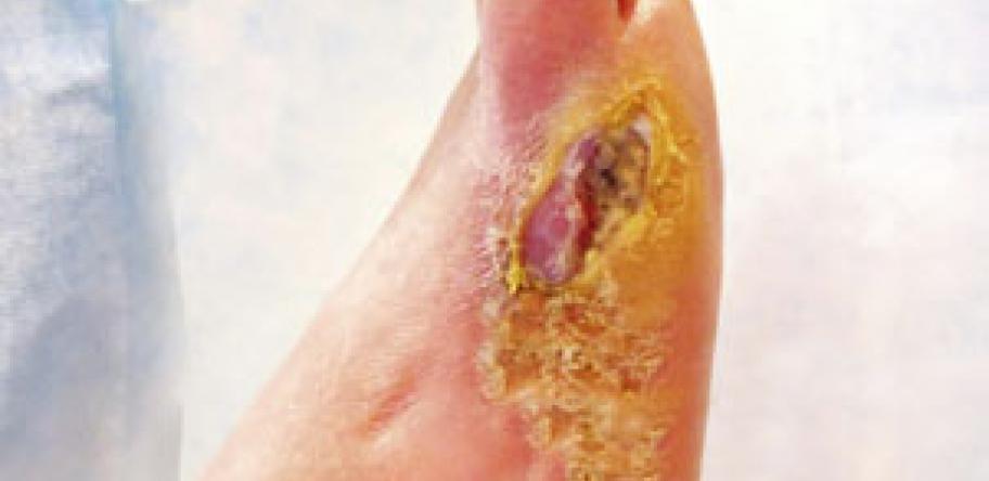 New thoughts on poor healing of foot ulcers Pharmacy News