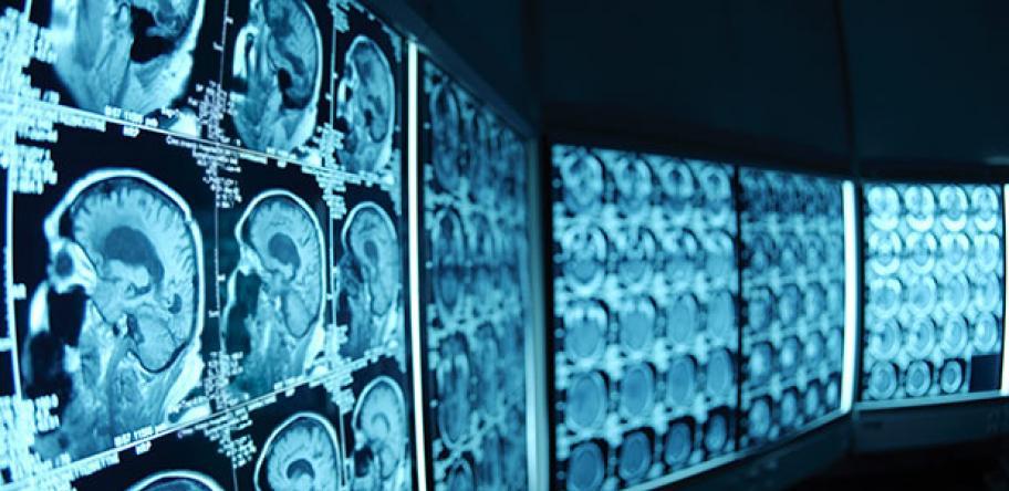 Challenger thrombolytic prevails in battle of the clot-busters